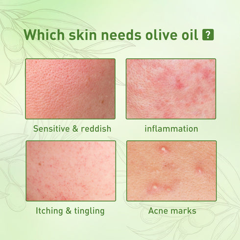 Remove Face Oil Acne Gentle Moisturizing Acne Pit Repair Liquid Fade Face Acne Marks Essential Oil - ROUTINE FASHION
